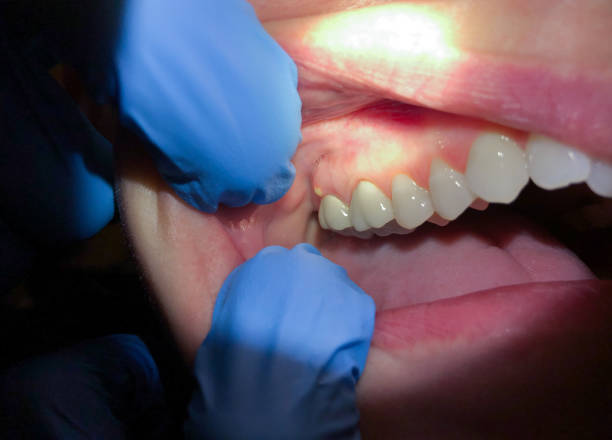 Best Emergency Care for Gum Disease in Blasdell, NY
